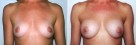 Breast Augmentation