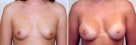 Breast Augmentation