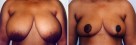 Breast Reduction