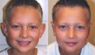 Otoplasty (Ear Set Back)