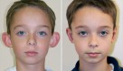 Otoplasty (Ear Set Back)