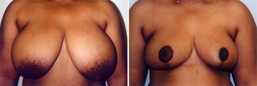 Breast Reduction Patient 1