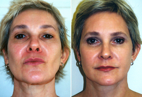 Facelift Patient 1