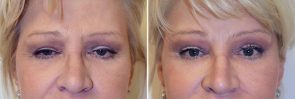 Eyelid Surgery Patient 2
