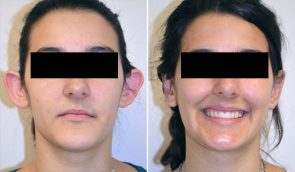 Otoplasty Patient 4