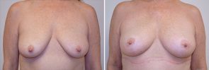 Breast Lift with Fat Grafting Patient 13