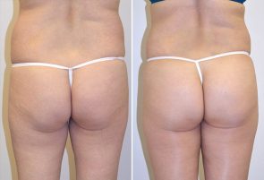 Fat Injections to the Buttocks