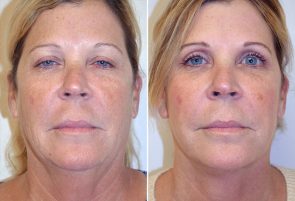 Facelift Patient 9