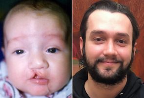 Cleft Lip Repair Patient 9