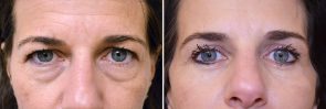 Eyelid Surgery Patient 5