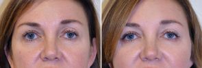 Eyelid Surgery Patient 9