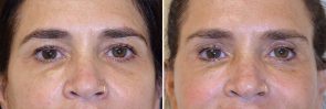 Eyelid Surgery Patient 6