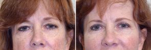 Eyelid Surgery Patient 8