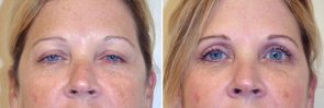 Eyelid Surgery Patient 7