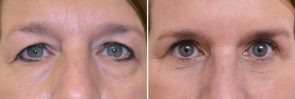 Eyelid Surgery Patient 11