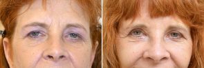 Eyelid Surgery Patient 10