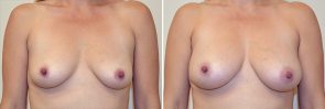 Micro-fat Grafting Breast Patient 3