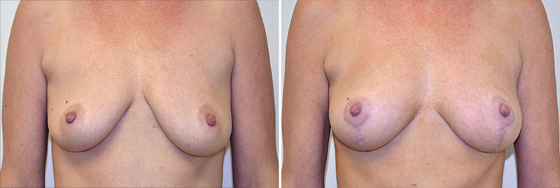 Breast Lift Patient 7