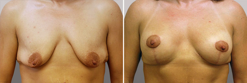Breast Lift Patient 8
