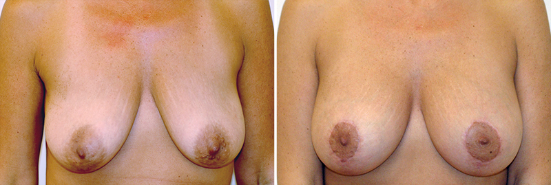Breast Lift with Augmentation Patient 2