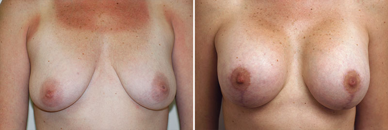 Breast Lift with Augmentation Patient 3
