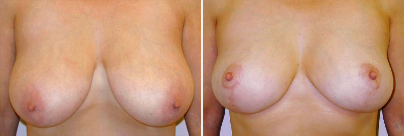 Breast Reduction Patient 3