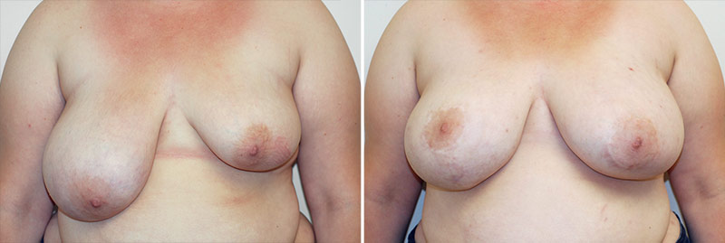 Breast Asymmetry Patient 1