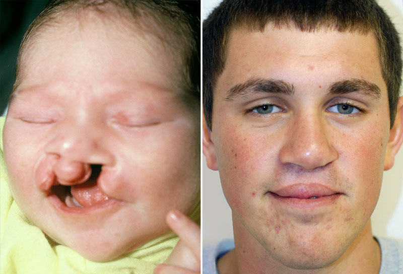 Cleft Lip Repair Patient 8