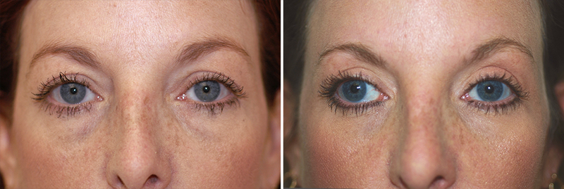 Eyelid Surgery Patient 1