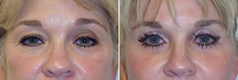 Eyelid Surgery Patient 3
