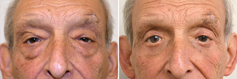 Eyelid Surgery Patient 4