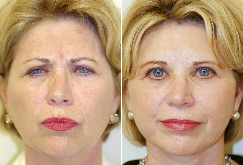 Facelift Patient 2