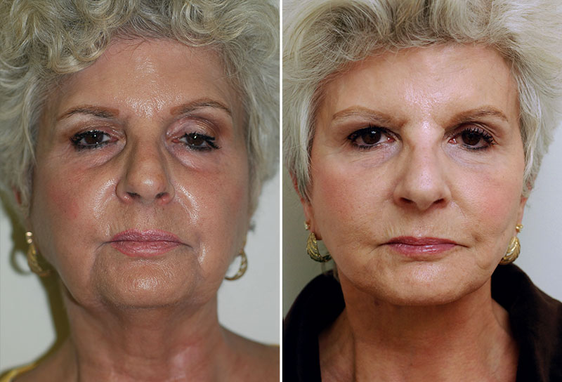 Facelift Patient 3