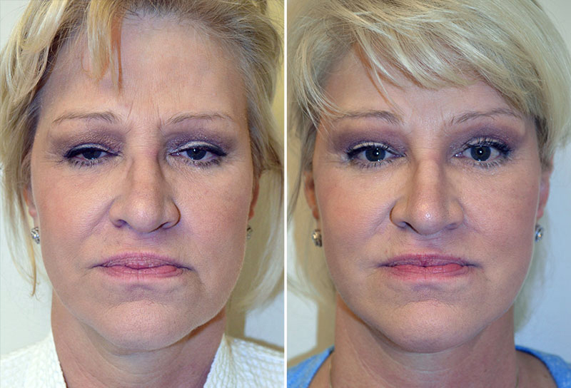 Facelift Patient 4