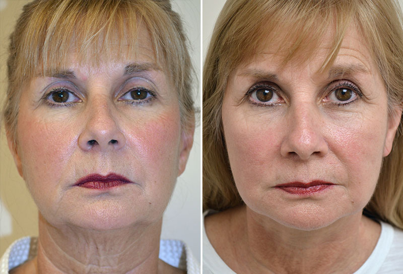 Facelift Patient 5