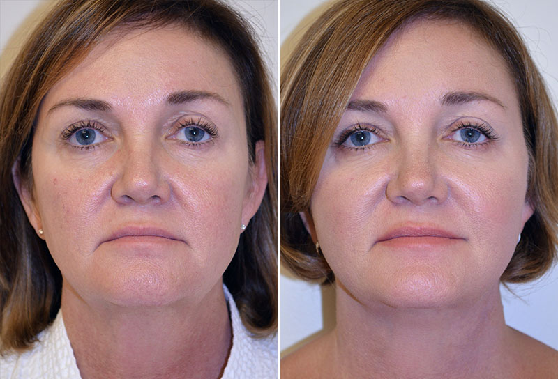 Facelift Patient 7