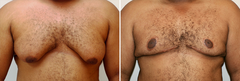 Male Breast Reduction Patient 1